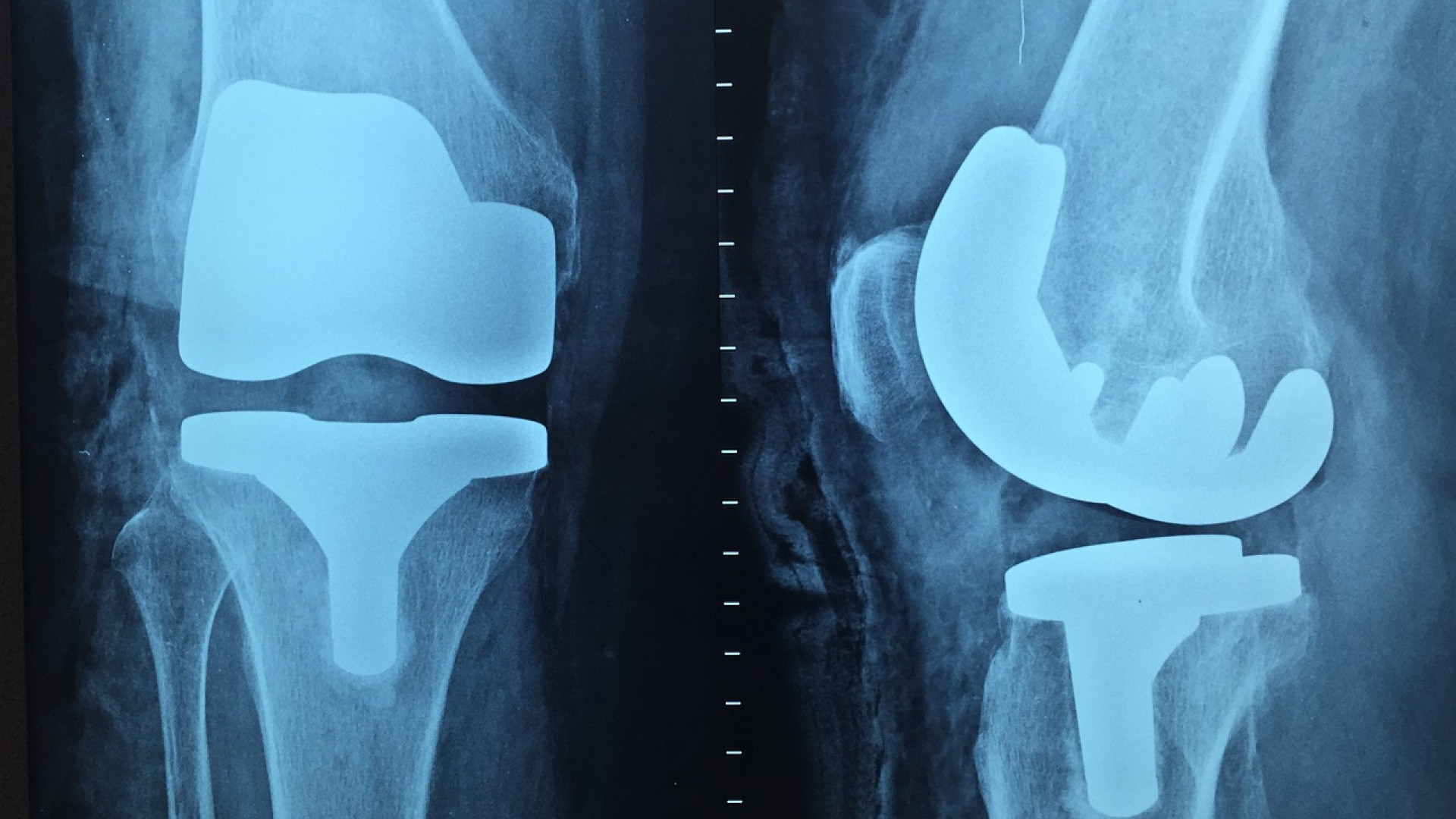 Que savoir sur la chirurgie du genou ?